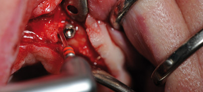 Minimalinvasive Implantatentfernung mittels Er:YAG-Laser