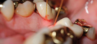 Parodontitistherapie ohne Antibiotikaeinsatz