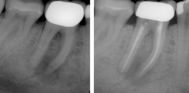 Laser – Sinnvoll für nachhaltigen Therapieerfolg in der Endodontie?
