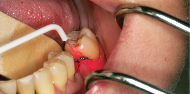 Das kombinierte Laser-Hochfrequenzgerät im Einsatz