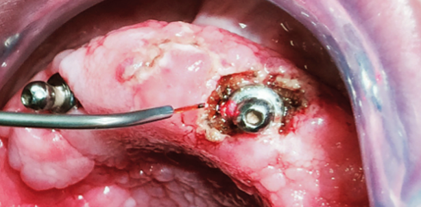 Lasertherapie von fibromatöser Prothesenstomatitis