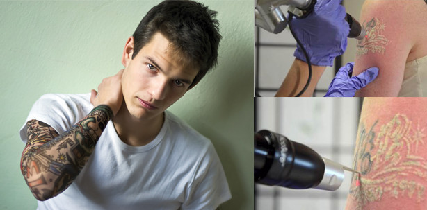 Die neue ultragepulste Lasertechnologie