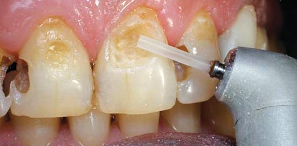 Laser im Vergleich mit Bohrer und Dentin-Bonding