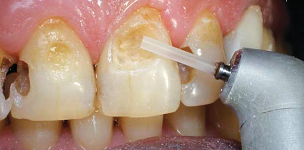 Laser im Vergleich mit Bohrer und Dentin-Bonding