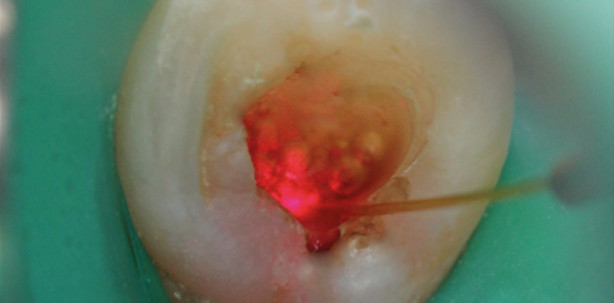 Keimreduktion mit einem 970-nm-Laser