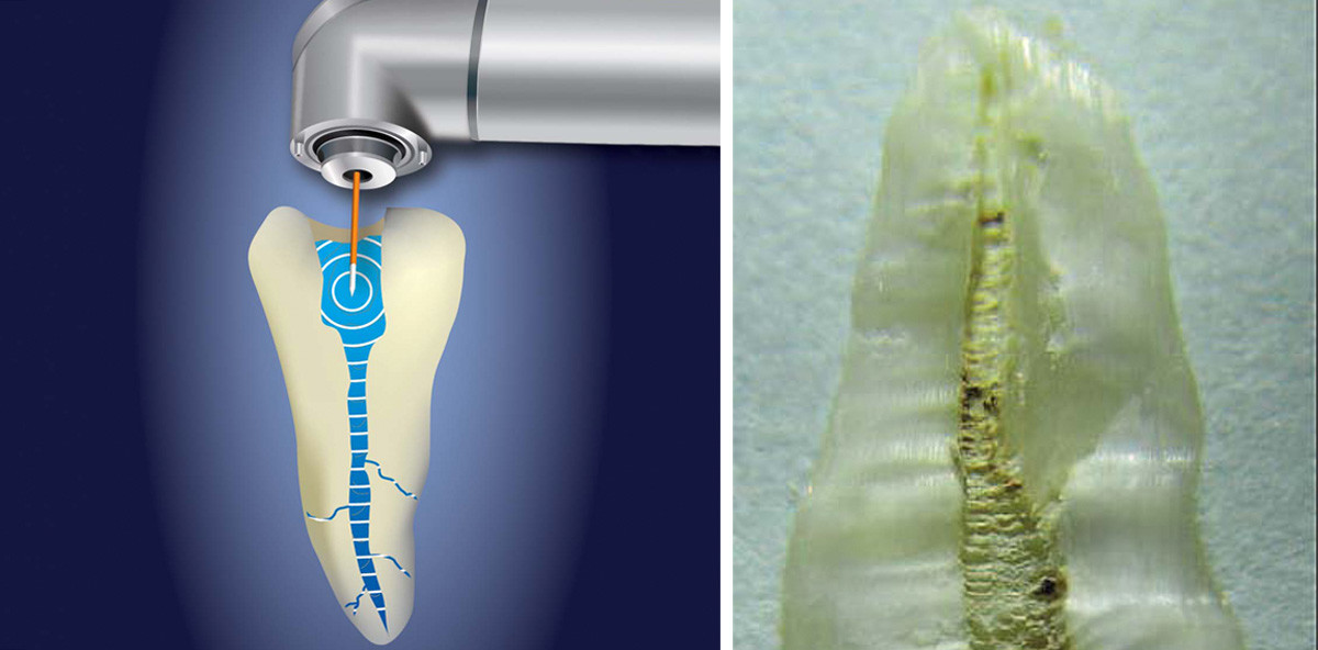 Laseraktivierte Spülung mit PIPS® – Die Macht der besseren Spülung