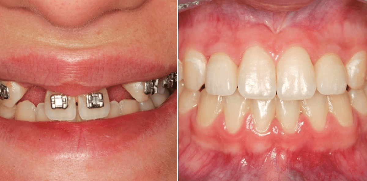 Minimalinvasive Implantation mit lateraler Augmentation im ästhetischen Bereich