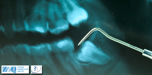 Aktualisierte Leitlinie „Operative Entfernung von Weisheitszähnen“