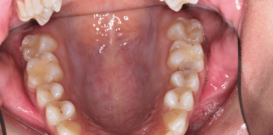 S1-Handlungsempfehlung „Kompositrestaurationen im Seitenzahnbereich“