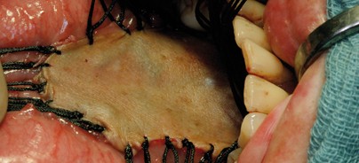 Epitheliale Vorläuferläsionen – Die orale Leukoplakie