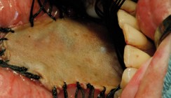 Epitheliale Vorläuferläsionen – Die orale Leukoplakie