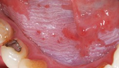 Leukoplakische Mundschleimhauterkrankungen in der Praxis