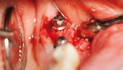 Schlüsselfaktor Er:YAG-Laser bei periimplantären Entzündungen