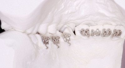 Die Königsteiner Hybrid-Technik