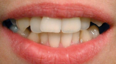 Die ASR in der Lingualbehandlung