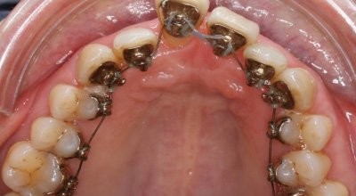 Lingualtechnik bei PA-geschädigtem Gebiss