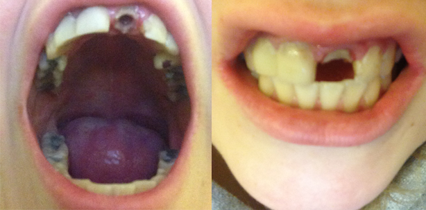 Zahnverlust durch Niesen: Frau aus England erlebt Albtraum