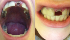 Zahnverlust durch Niesen: Frau aus England erlebt Albtraum