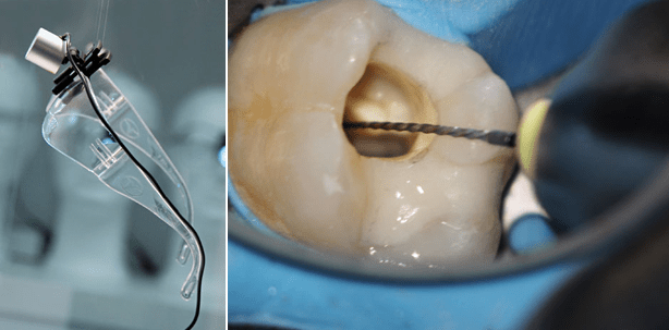 Schärfer sehen, zeitnah kontrollieren, weniger Feilen