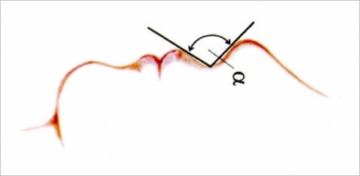 Lippenspaltverschluss nach Franz König