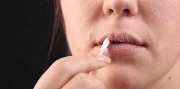 Anfassen verboten – Lippenherpes überträgt sich schnell