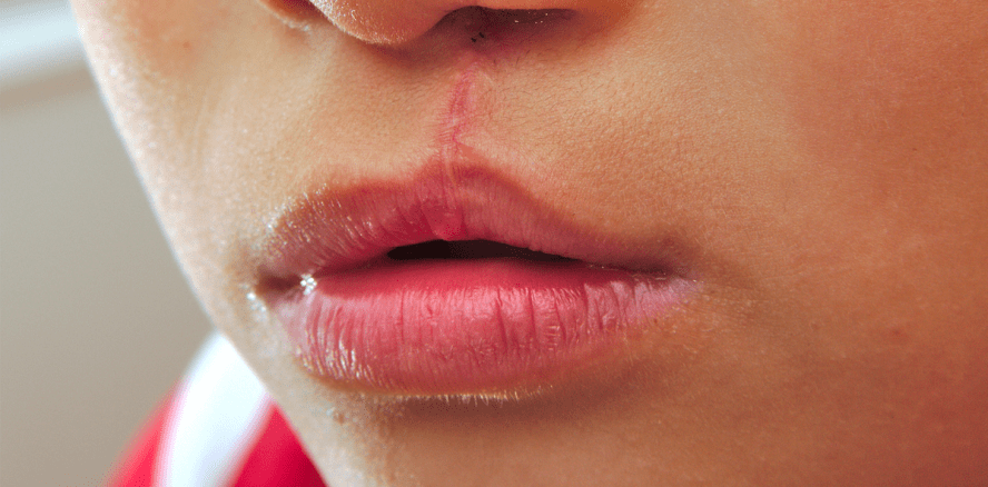 Immer mehr Lippen-Kiefer-Gaumen-Spalten