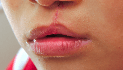 Immer mehr Lippen-Kiefer-Gaumen-Spalten