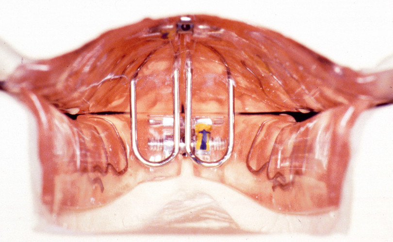 Herausnehmbare Apparaturen in der KFO