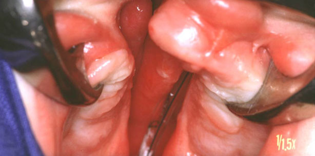 LKG-Spalte: 21-jähriger glücklich nach „Behandlungsmarathon“