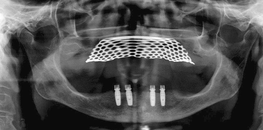 Implantatgestützte Locator®-Prothese zur Versorgung zahnloser Kiefer