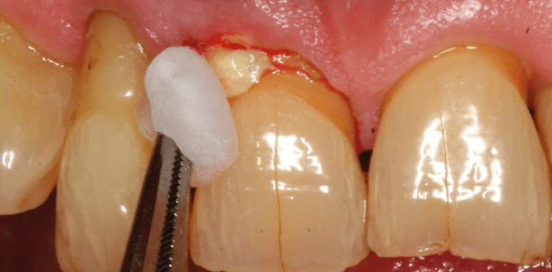 Lokalantibiotika: ergänzendes Hilfsmittel gegen Taschen