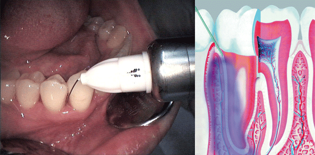 Lokalanästhesie vs. Zeit sparen