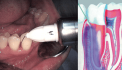 Lokalanästhesie vs. Zeit sparen
