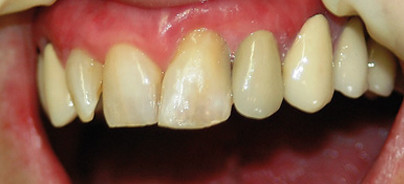 Die Kompositfüllung mit Flow