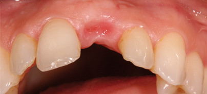 Behandlung und Therapie einer Einzelzahnlücke