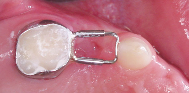 Lückenhalter und Kinderprothesen bei Zahnverlust