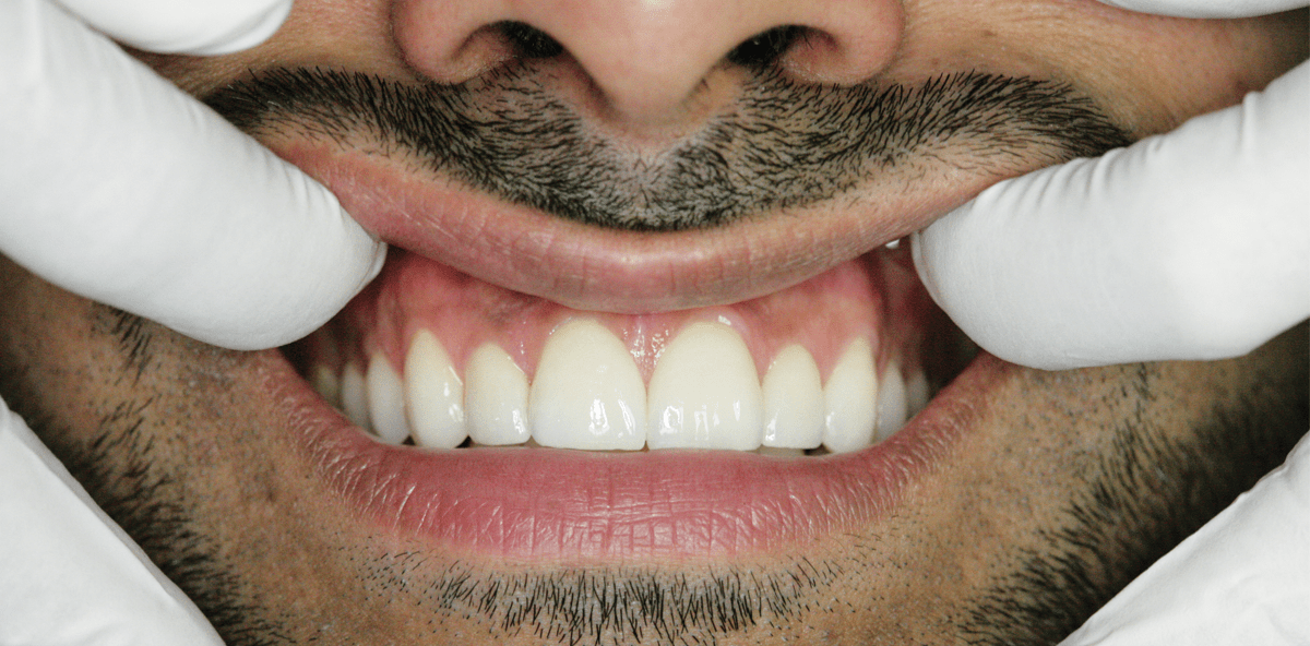 Ästhetischer Lückenschluss der Oberkieferfrontzähne mithilfe keramischer Veneers