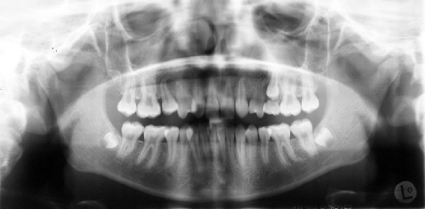 Kieferorthopädischer oder prothetischer Lückenschluss bei Nichtanlagen? – Teil II