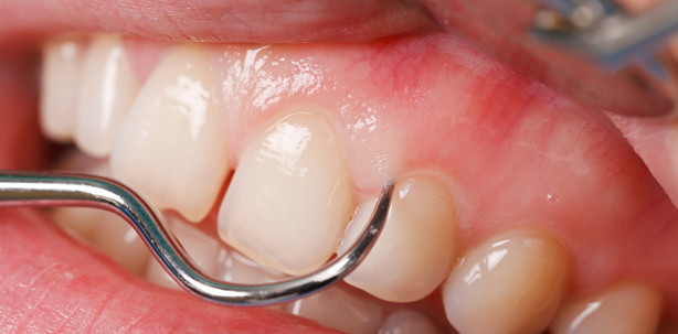 Marfan-Syndrom: kein erhöhtes Parodontitisrisiko