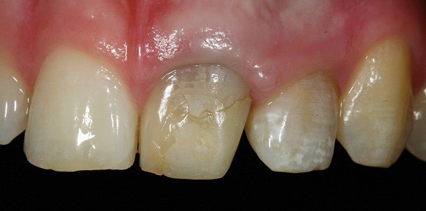 Therapie irreversibel verfrbter Zahnstmpfe im Frontzahnbereich ZWP online das Nachrichtenportal fr die Dentalbranche Therapie irreversibel verfrbter Zahnstmpfe im Frontzahnbereich ZWP online das Nachrichtenportal fr die Dentalbranche