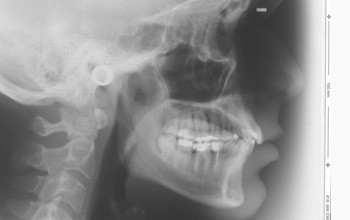 Linguale Orthodontie nach Maß