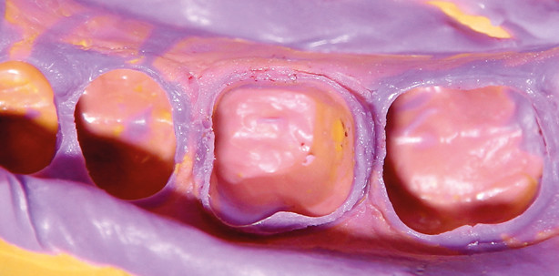 Materialoptimierung für stressfreie Abformungen