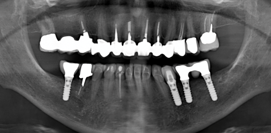 Vollkeramik in der Front, Metallkeramik im Seitenzahnbereich