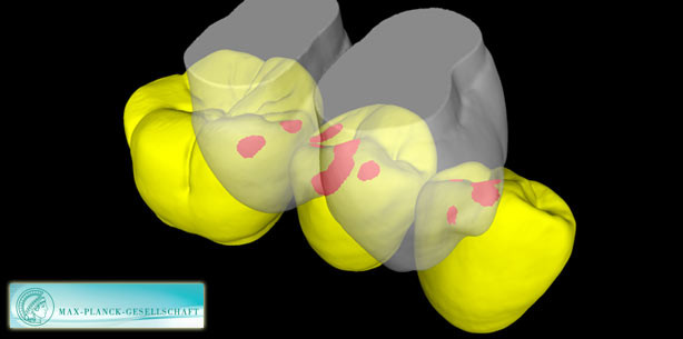 Materialverlust schützt Zähne gegen Ermüdungsbruch