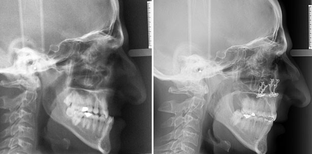 Die Rolle der Maxillaimpaktion bei Klasse III-Dysgnathien