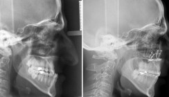 Die Rolle der Maxillaimpaktion bei Klasse III-Dysgnathien