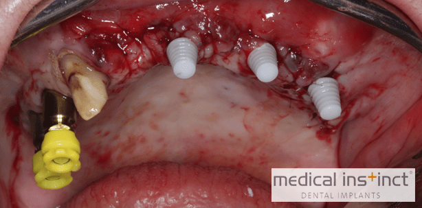 BoneTrust® mini Implantatsystem