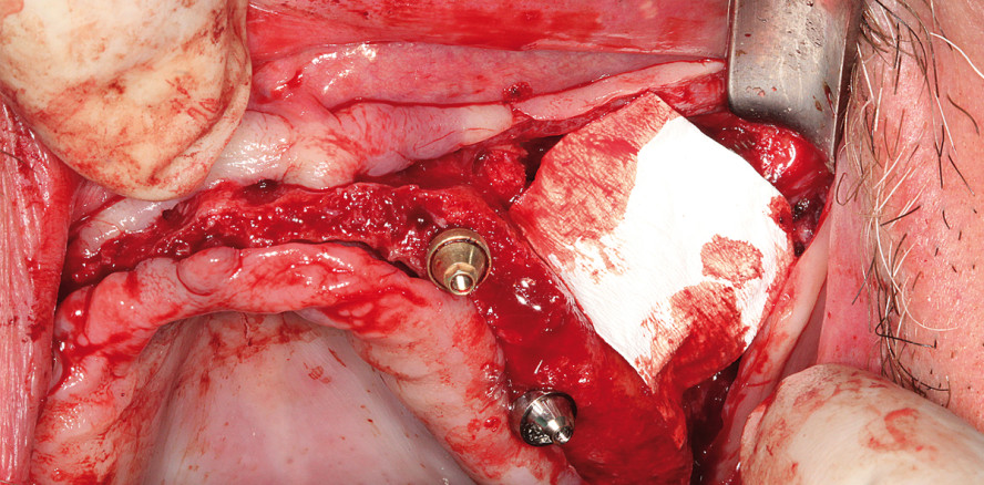 Festsitzende Prothetik im ­Oberkiefer bei geringem ­distalen Knochenangebot