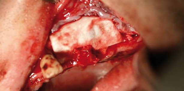 Membranen in der zahnärztlichen Chirurgie und der Kieferchirurgie