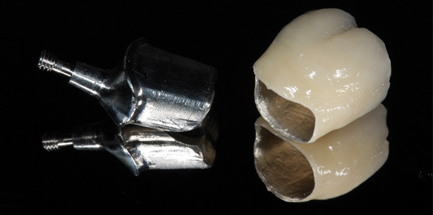 Metall oder Vollkeramik?